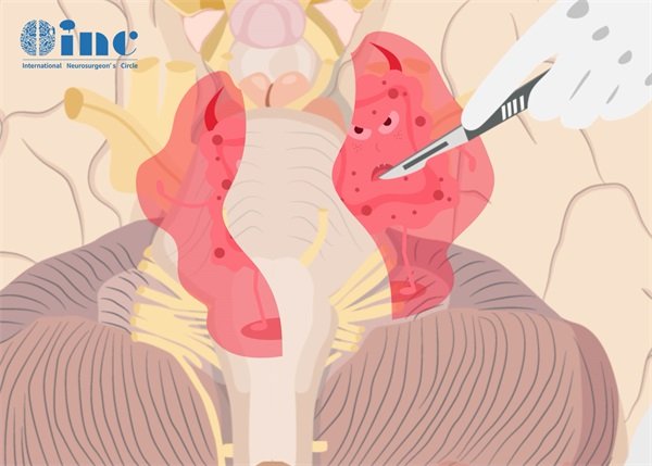 顱內(nèi)海綿狀腦血管瘤多大會死?能直接手術(shù)嗎?