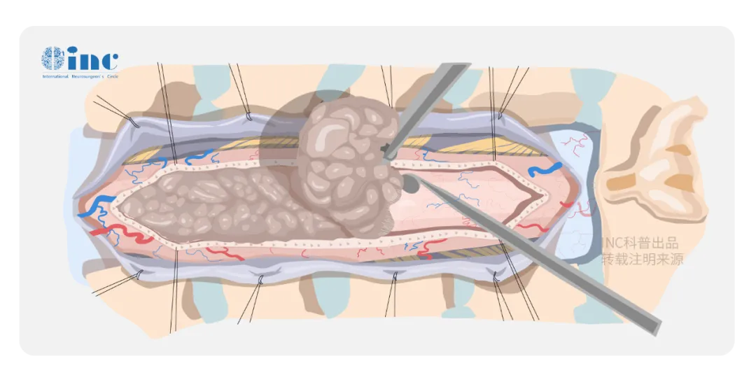 脊髓腫瘤選擇放療還是手術(shù)？能全切嗎