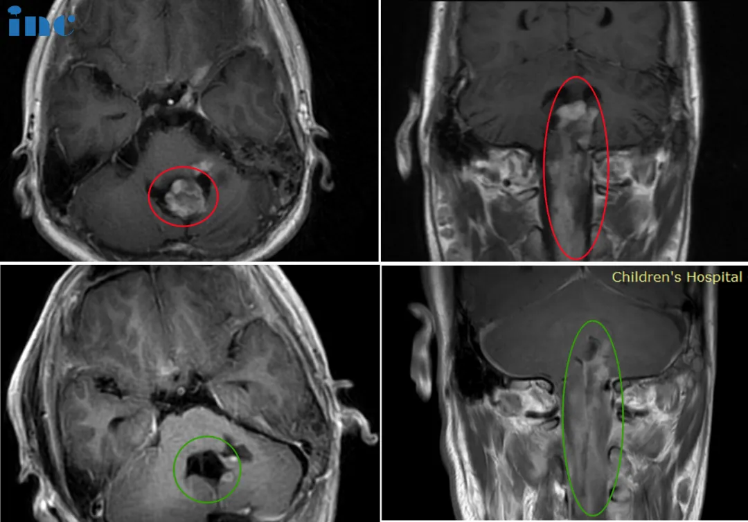 14歲男孩-脊髓髓內(nèi)節(jié)細(xì)胞膠質(zhì)瘤