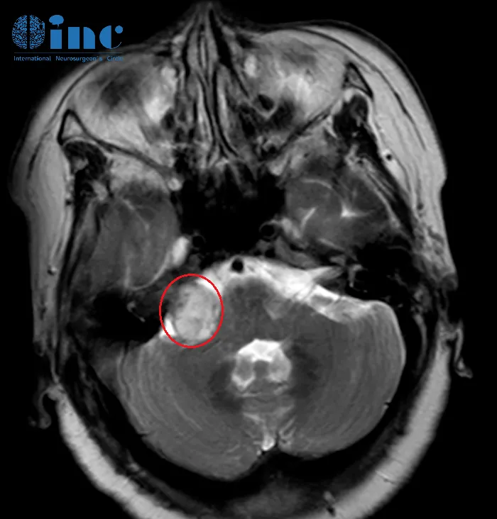 聽(tīng)神經(jīng)瘤+腦積水