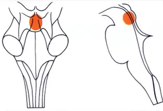 中腦頂蓋膠質(zhì)瘤