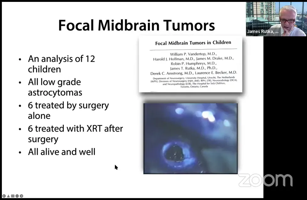中腦局灶性被蓋腫瘤