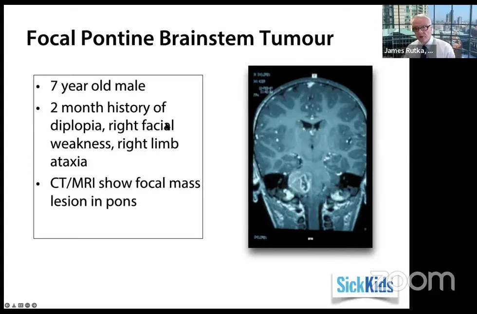 7歲男孩，復(fù)視、右面部無(wú)力、右肢體共濟(jì)失調(diào)2個(gè)月病史，CT/MRI顯示腦橋局灶性腫塊。
