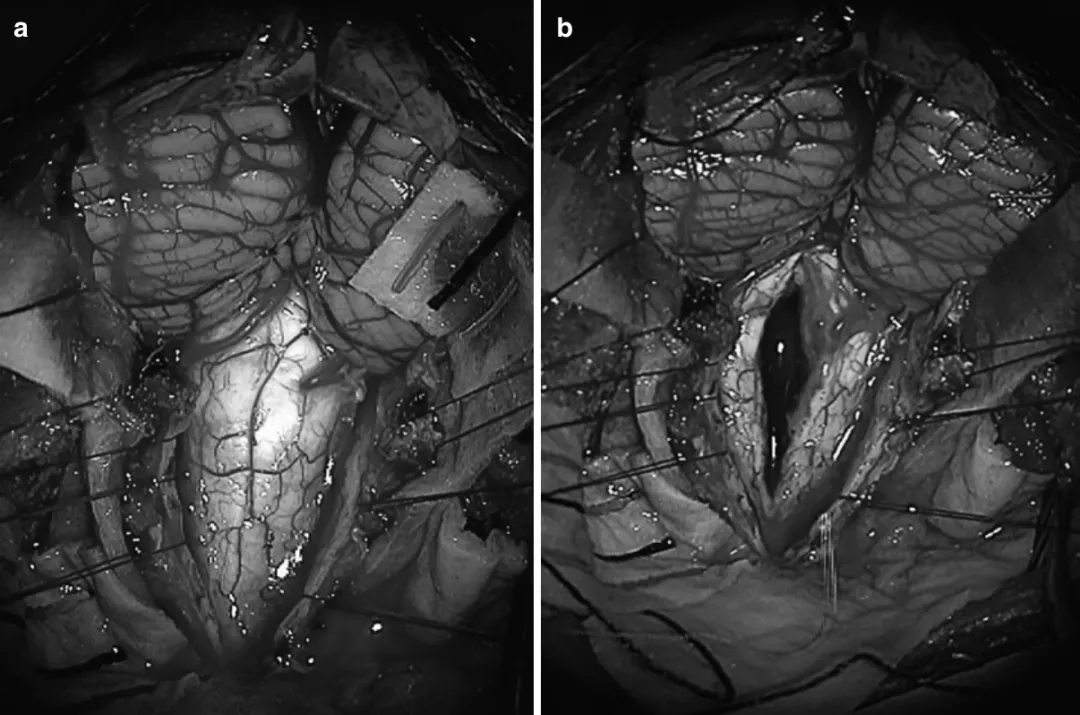 圖：延髓-頸髓膠質(zhì)瘤的術(shù)中照片圖，（a）后顱窩開顱后，可見延髓-頸髓膠質(zhì)瘤，在連續(xù)的術(shù)中神經(jīng)電生理（IONM）監(jiān)測(cè)下，使用CUSA超聲刀切除了腫瘤。(b)顯示腫瘤切除后的即時(shí)照片，顯示脊髓后正中線切開和延髓-頸髓膠質(zhì)瘤的切除。