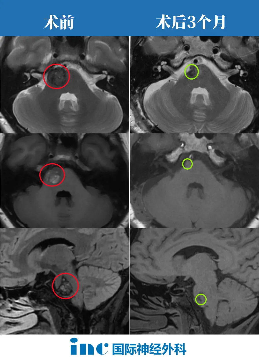 腦干海綿狀血管瘤出血危機(jī)，香港患者慕名赴蘇求醫(yī)、成功手術(shù)！