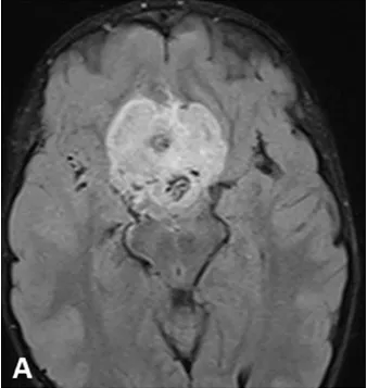 為什么很多人認(rèn)為視神經(jīng)膠質(zhì)瘤無法手術(shù)？INC國際教授成功手術(shù)理念和案例分享