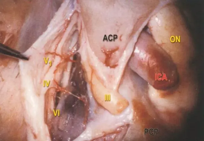 前床突腦膜瘤嚴(yán)重嗎？手術(shù)難度大嗎？