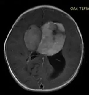 一歲小朋友巨大視神經(jīng)膠質(zhì)瘤
