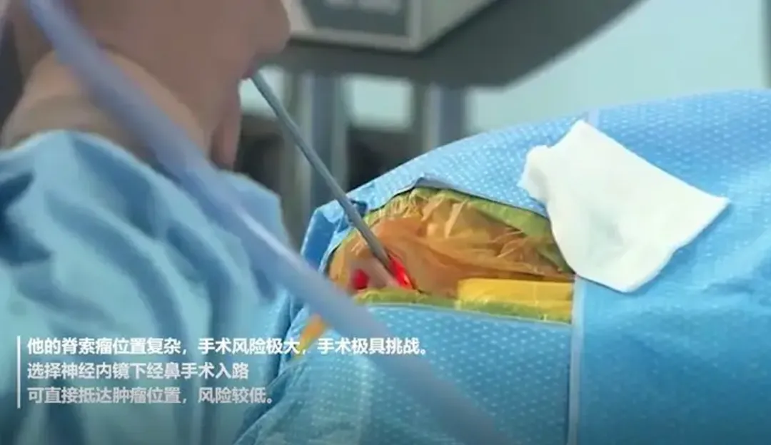 高難度顱底斜坡脊索瘤全切1