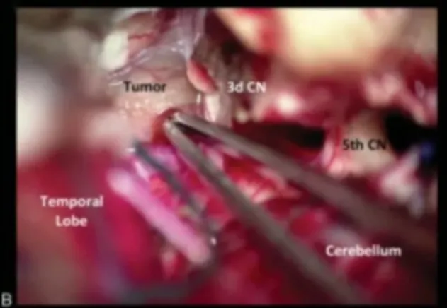 腳間池蛛網(wǎng)膜的初步解剖分離，腫瘤的暴露。