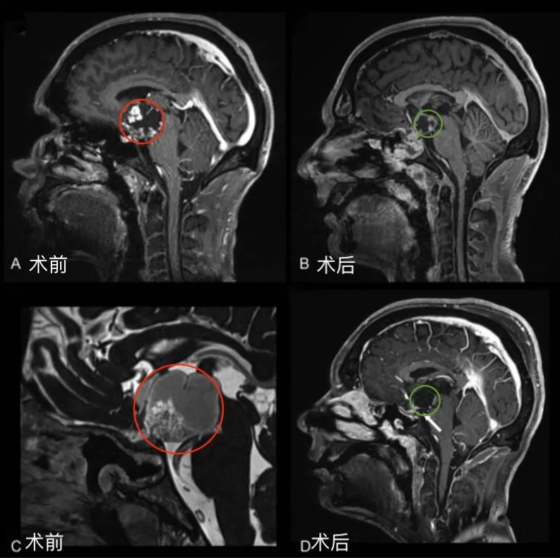 圖1后視交叉性巨大顱咽管瘤患者腫瘤術(shù)前（A，C）和術(shù)后（B,D）矢狀位增強(qiáng)MR對(duì)比，顯示腫瘤全切。