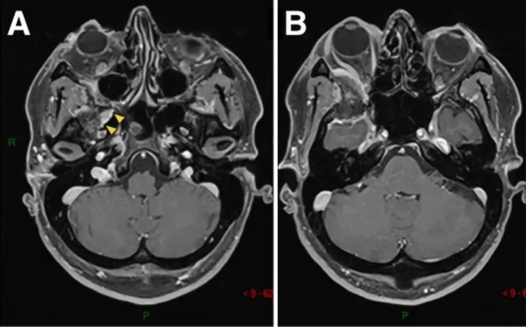 圖1A-D：術(shù)前MR顯示蝶眶區(qū)腫瘤占位，增強(qiáng)均勻病灶，浸潤(rùn)延伸至翼腭窩（黃色箭頭）。