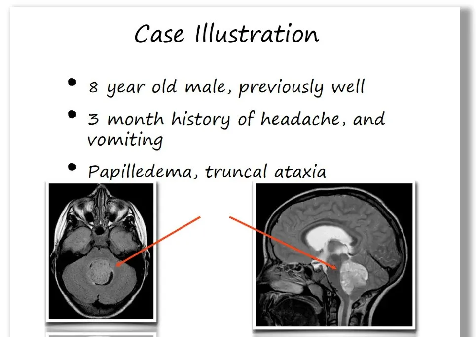 Rutka教授案例分享：髓母細(xì)胞瘤聯(lián)合治療，良好生存長(zhǎng)達(dá)8年
