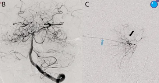 常規(guī)二維血管造影