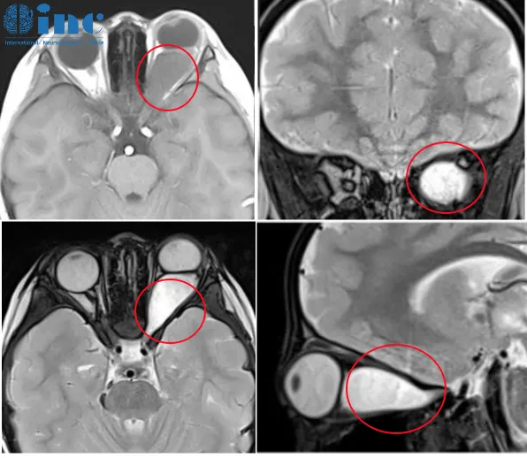 “一只眼也可以做得很好！” 這種視神經(jīng)膠質(zhì)瘤手術(shù)后可能失明！