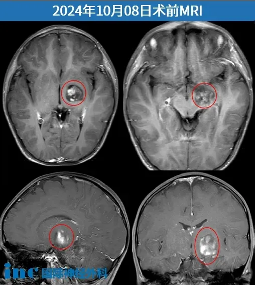 術(shù)前，巴教授查看小杰的DTI重建