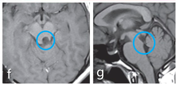 c圖表示通過左側(cè)小腦上天幕下入路全切腫瘤。d圖顯示整個外側(cè)枕骨區(qū)域暴露在下，直到滑車神經(jīng)出口(箭頭所示)。e圖表示腦干的進入點選擇在上丘腦的側(cè)面，最后的腫瘤切除腔約6mm