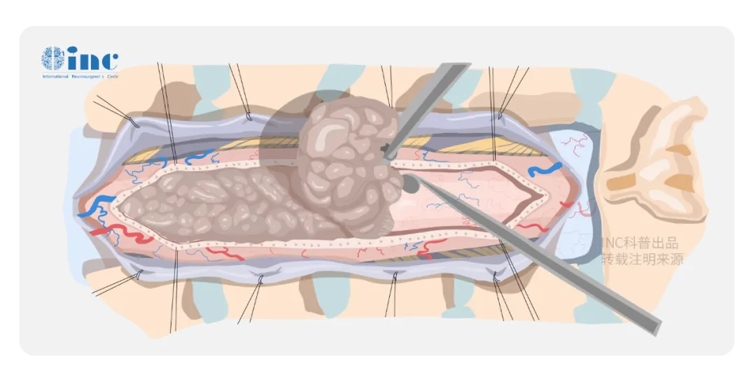 脊髓腫瘤手術有多難？難在哪兒？