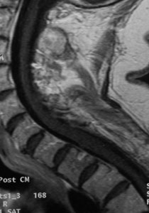術后MRI掃描顯示腫瘤已被完全移除，患者脊髓的壓力得到了有效緩解。