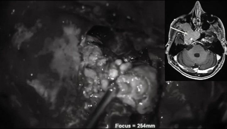 前內(nèi)側(cè)三角部位腫瘤切除