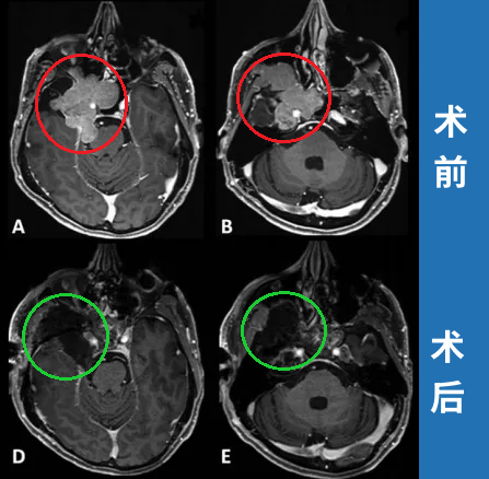 手術(shù)順利完成，根據(jù)術(shù)前術(shù)后影像對比，患者腫瘤得到完全切除。