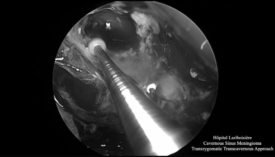 神經(jīng)內(nèi)鏡操作下暴露和切除腫瘤