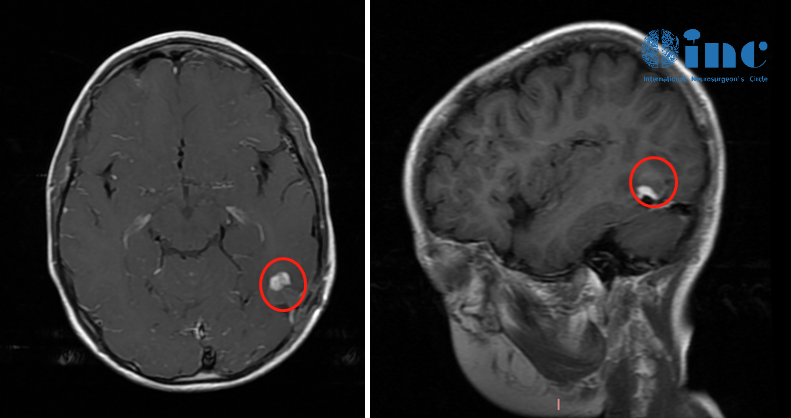 很快，安安接受了癲癇病灶切除術(shù)，術(shù)后病理結(jié)果顯示為兒童型彌漫性低級別膠質(zhì)瘤（WHO II級）。然而，時間到了2022年，在一次常規(guī)復(fù)查時，安安的腫瘤竟然復(fù)發(fā)了。