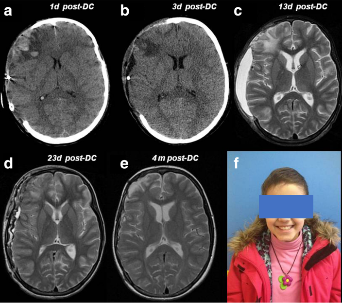 圖 1：一名 11 歲女孩遭受嚴(yán)重頭部損傷，接受右側(cè)腦半球去骨瓣減壓術(shù)（a - c），并在初次手術(shù) 20 天后進(jìn)行自體骨瓣替換（d、e）。在 3 年隨訪中，神經(jīng)狀況良好（格拉斯哥結(jié)果量表 GOS 5 分），顱骨成形術(shù)成功（f）。