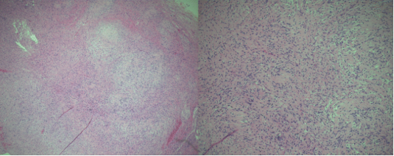 蘇木精- 伊紅染色的組織學(xué)標(biāo)本顯示細(xì)胞區(qū)域含柵欄狀排列的細(xì)胞核（安托尼 A 型），交替出現(xiàn)少細(xì)胞區(qū)域由疏松水腫間質(zhì)中不規(guī)則排列的細(xì)胞構(gòu)成（安托尼 B 型）。