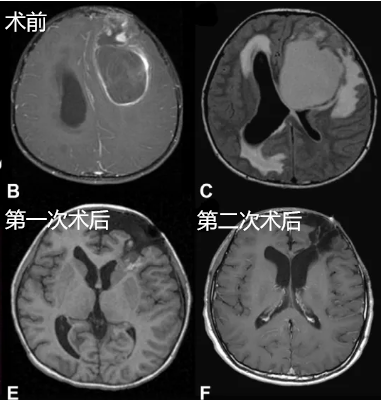 INC國際兒童腦瘤手術(shù)大咖James T. Rutka教授James T. Rutka教授在研究中稱，手術(shù)切除的范圍已被確定為影響預(yù)后的主要因素，有證據(jù)表明，大多數(shù)復(fù)發(fā)發(fā)生在原發(fā)腫瘤的部位，且在未完全切除患兒中的復(fù)發(fā)率較高。