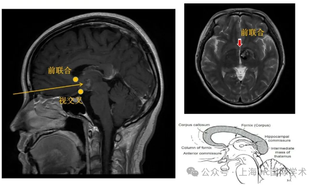 得了這種腦瘤，開顱風(fēng)險(xiǎn)高？做放療竟引發(fā)出血和多處腦血管病變
