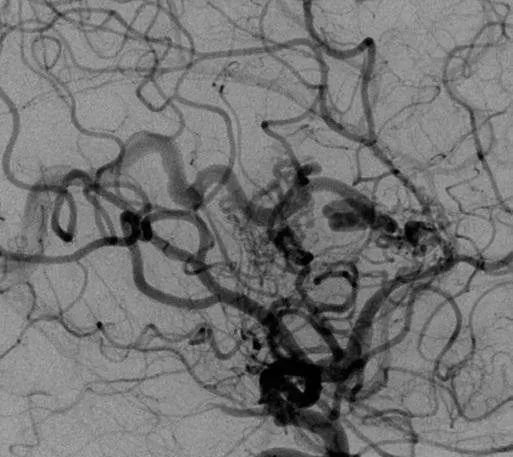 該AVM由ACA/PcaA分支、ACoA穿支和mPChA供血[右側(cè)ICA造影