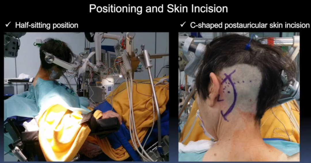 行乙狀竇后髁上入路、腦干安全區(qū)橄欖區(qū)入路，手術(shù)體位，半坐位，頭稍屈，左側(cè)耳后切口C形，并進行術(shù)中MEP、SEP和舌下肌電圖(hypoglossal EMG)監(jiān)測。