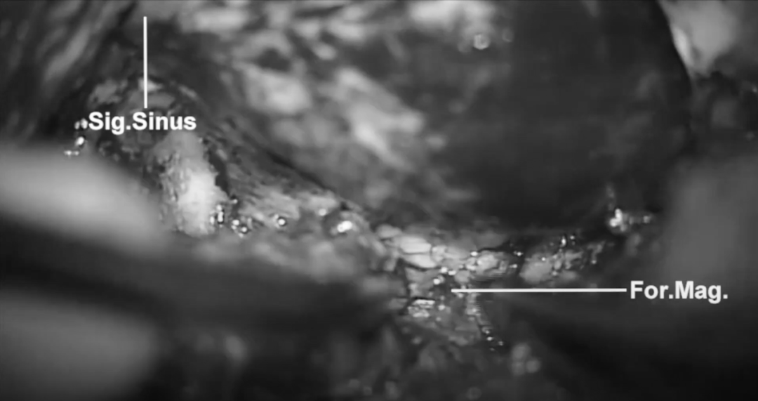 乙狀竇后入路開顱