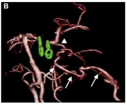 術(shù)后3D CTA顯示左側(cè) PCA 區(qū)血管穿支(箭頭)和重建的PTA血管(箭頭)的血流通暢。