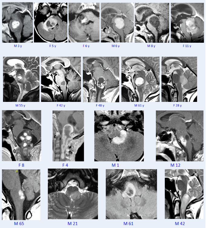 巴教授毛星手術(shù)案例系列分享