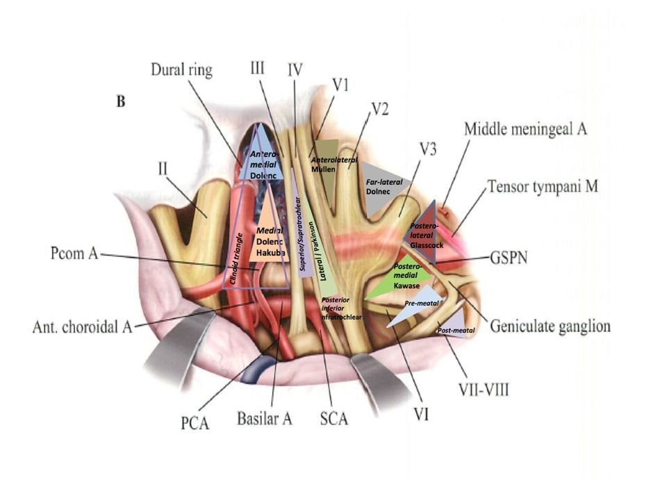 圖：經(jīng)硬膜外和硬膜內(nèi)利用11個三角間隙充分顯露的海綿竇，每個三角間隙可以作為安全進入海綿竇的手術(shù)路徑（圖Practical-Handbook-of-Neurosurgery-From-Leading-Neurosurgeons，改良后）。