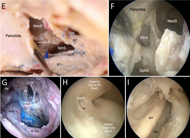 經(jīng)擴大的 AMT 開辟入路至蝶竇（SphS）