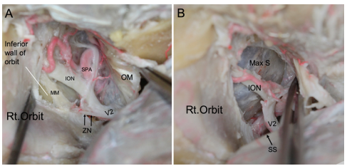 翼腭窩(PPF)的下移及眶翼腭走廊(OPC)的逐步暴露