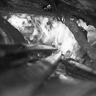 INC羅頓教授緊急為他手術(shù) —— 雙側(cè)開顱，“左右夾擊”拆炸彈