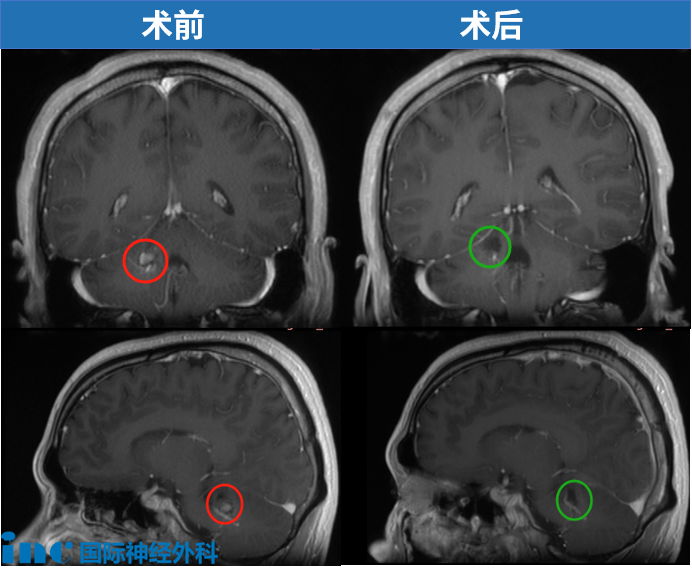 術(shù)前術(shù)后影像
