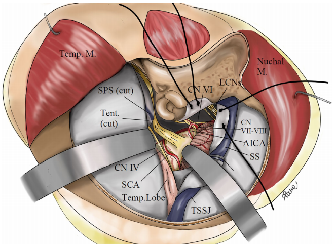 手術(shù)通道示意圖：右側(cè)微聯(lián)合巖骨入路(mini-CTPA)