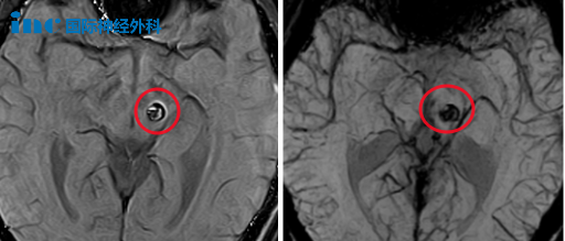  2023年6月23日，小林第1次出血