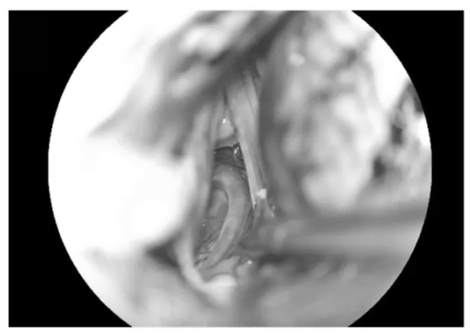 逐步暴露椎動(dòng)脈、PICA及延髓側(cè)方