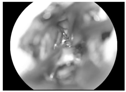 可見(jiàn)黃染的含鐵血黃素沉積帶