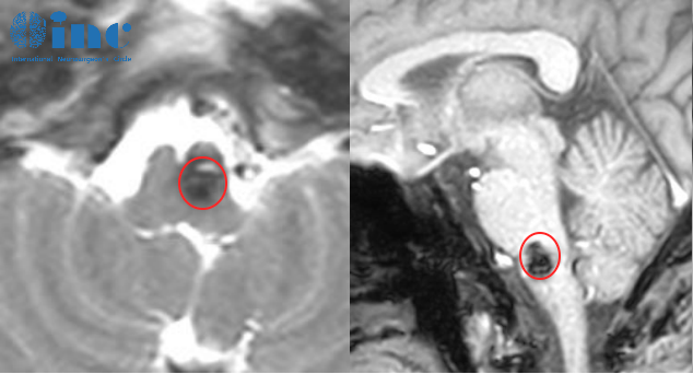 延髓海綿狀血管瘤伴出血