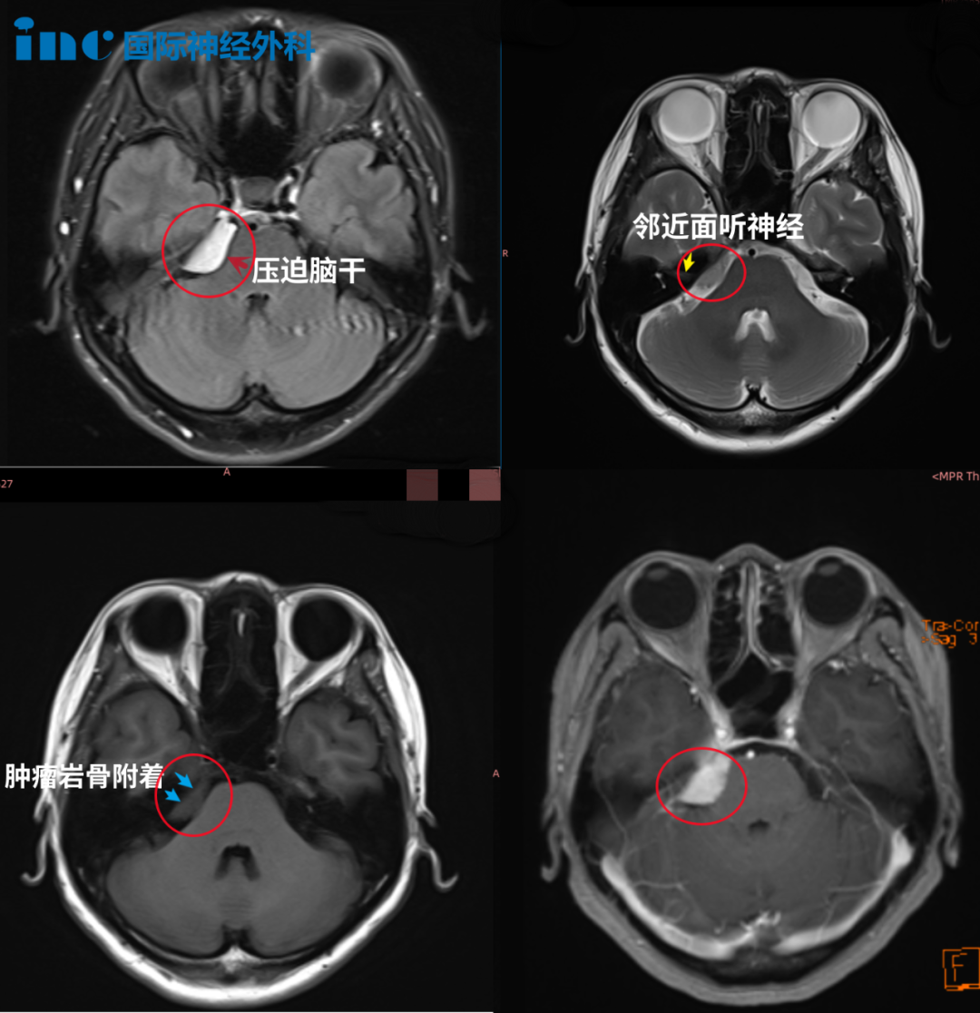 醫(yī)生告知，右側(cè)橋小腦角（CPA）區(qū)占位，腫瘤位置與三叉神經(jīng)、面聽神經(jīng)、滑車神經(jīng)等重要顱神經(jīng)及海綿竇、小腦關(guān)系密切，已經(jīng)壓迫到腦干，手術(shù)治療傷及神經(jīng)的風(fēng)險很大，也就是說如果手術(shù)做不好，可能面癱、聽力喪失、肢體癱瘓，甚至昏迷等。