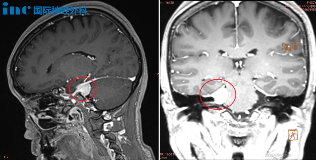 恐怖如斯，21年10月，鐘女士在醫(yī)生的建議下選擇了伽馬刀治療，可是并沒有明顯治療效果，這使她更焦慮了。