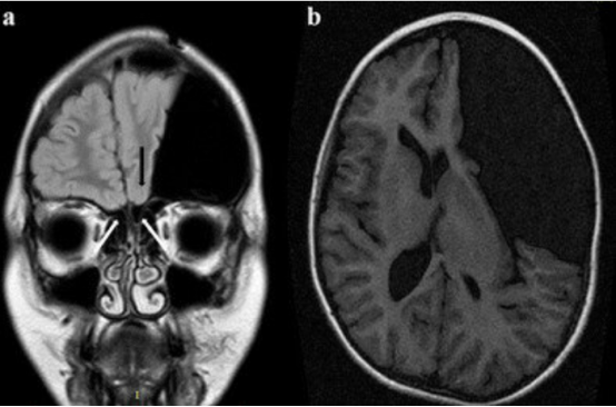 示例病例的術(shù)前 MRI(冠狀面)顯示嗅球缺失(白箭頭)，左側(cè)嗅溝發(fā)育不全(黑箭頭)。左側(cè)眶回和右側(cè)回分化不良，部分被蛛網(wǎng)膜囊腫壓迫;b 注意左側(cè)較大的外側(cè)裂蛛網(wǎng)膜囊腫(術(shù)前 MRI 軸面)。
