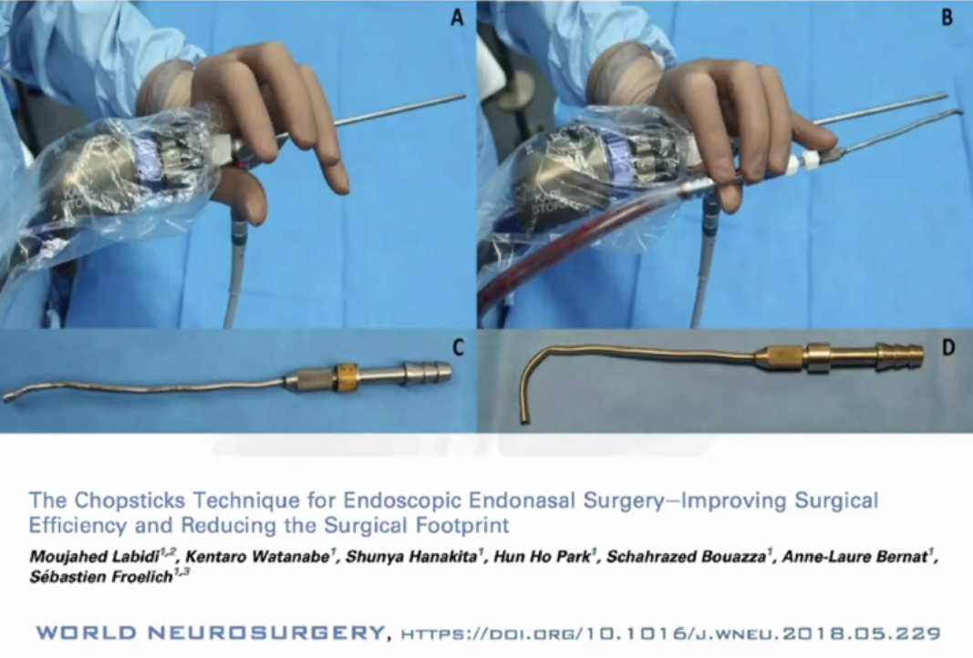 福教授在內(nèi)鏡輔助下行遠(yuǎn)外側(cè)經(jīng)髁入路手術(shù)，并采用他獨創(chuàng)的“筷子技術(shù)（chopsticks technique）”，最終成功切除腫瘤。